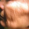 Fraxel can smooth out wrinkles and fine lines.
BEFORE PHOTO (Face)