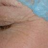 Fraxel can also be spot treated.  Great alternative to Botox.  Longer lasting results permanently. 
BEFORE PHOTO (Crow's feet)