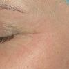 Fraxel can also be spot treated.  Great alternative to Botox.  Longer lasting results permanently. 
AFTER PHOTO (Crow's feet)