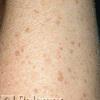 Fraxel can also treat deeper,  more difficult dark spots.
BEFORE PHOTO (Arms)
