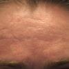 Lifting and smoothing out wrinkles and fine lines.
BEFORE PHOTO (Forehead)