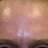 Lifting and smoothing out wrinkles and fine lines.
AFTER PHOTO (Forehead)