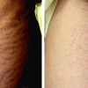 Microneedle Therapy for Stretch Marks