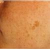 Hyperpigmentation can be a result of sun damage,  birth control,  pregnancy or aging.
BEFORE PHOTO (Face)