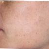 IPL Intense Pulsed Light treatments will fade darks spots and vascular redness.
AFTER PHOTO (Face)