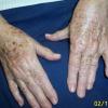 IPL Intense Pulsed Light can also be treated on various parts of the body
BEFORE PHOTO (Hands)