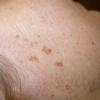 Hyperpigmentation can be a result of sun damage,  birth control,  pregnancy or aging.
BEFORE PHOTO (Face)